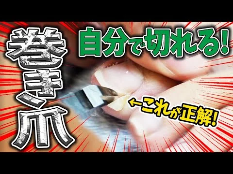 画像 【巻き爪　爪切り　自分で治す】爪切り　ヤスリの詳しい実践動画あり！まずは自分で爪を切ってみよう。